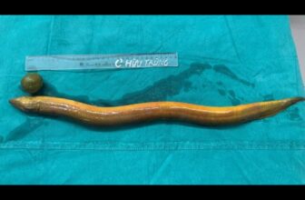 Man Sticks 2-Foot Eel up His Butt, Will get Surgical procedure After Eel Chews Via His Intestines